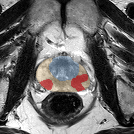 Peripheral-zone lesion, mid-gland (Case 103) MRI preview