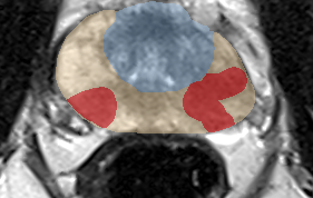 Peripheral-zone lesion, mid-gland (Case 103) lesion zoom preview