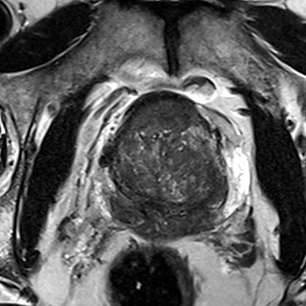 Transition-zone lesion, base (Case 138) T2 axial source preview