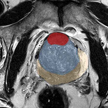 Transition-zone lesion, base (Case 138) MRI preview