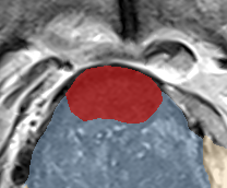 Transition-zone lesion, base (Case 138) lesion zoom preview