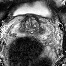 Peripheral-zone lesion, base (Case 29) T2 axial source preview