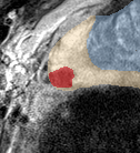 Peripheral-zone lesion, base (Case 29) lesion zoom preview