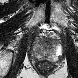 Peripheral-zone lesion, apex (Case 75) T2 axial source preview