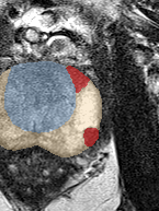 Peripheral-zone lesion, apex (Case 75) lesion zoom preview