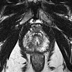 Peripheral-zone lesion, apex (Case 35) T2 axial source preview