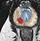 Peripheral-zone lesion, apex (Case 35) lesion zoom preview