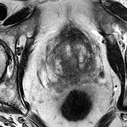 Normal gland anatomy, no lesion (Case 55) T2 axial source preview