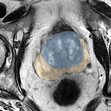 Normal gland anatomy, no lesion (Case 55) MRI preview
