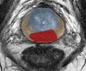 Peripheral-zone lesion, mid-gland (Case 45) lesion zoom preview