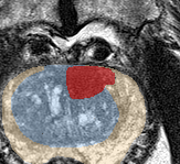 Transition-zone lesion, apex (Case 146) lesion zoom preview
