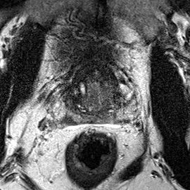 Peripheral-zone lesion, base (Case 118) T2 axial source preview