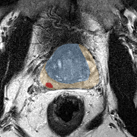 Peripheral-zone lesion, base (Case 118) MRI preview