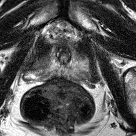 Peripheral-zone lesion, apex (Case 27) T2 axial source preview
