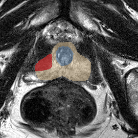 Peripheral-zone lesion, apex (Case 27) MRI preview