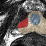 Peripheral-zone lesion, apex (Case 27) lesion zoom preview