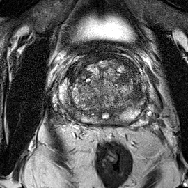 Normal gland anatomy, no lesion (Case 116) T2 axial source preview
