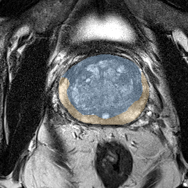 Normal gland anatomy, no lesion (Case 116) MRI preview