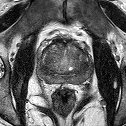 Normal gland anatomy, no lesion (Case 44) T2 axial source preview
