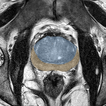 Normal gland anatomy, no lesion (Case 44) MRI preview