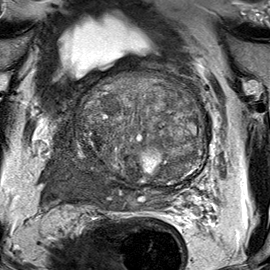 Peripheral-zone lesion, mid-gland (Case 59) T2 axial source preview