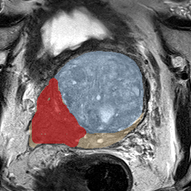Peripheral-zone lesion, mid-gland (Case 59) MRI preview