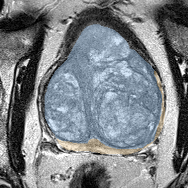 Normal gland anatomy, no lesion (Case 34) MRI preview