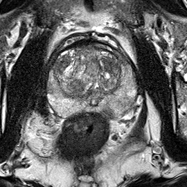 Peripheral-zone lesion, mid-gland (Case 96) T2 axial source preview