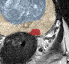 Peripheral-zone lesion, mid-gland (Case 96) lesion zoom preview