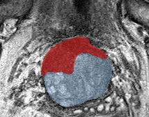 Transition-zone lesion, anterior (Case 25) lesion zoom preview