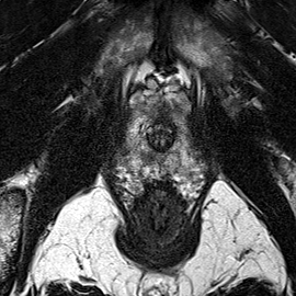Peripheral-zone lesion, apex (Case 20) T2 axial source preview