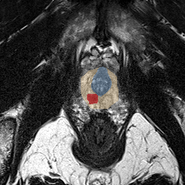 Peripheral-zone lesion, apex (Case 20) MRI preview