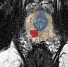 Peripheral-zone lesion, apex (Case 20) lesion zoom preview