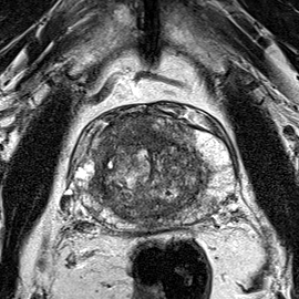 Transition-zone lesion, mid-gland (Case 25) T2 axial source preview