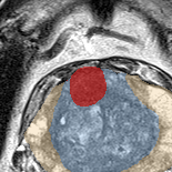 Transition-zone lesion, mid-gland (Case 25) lesion zoom preview