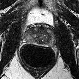Peripheral-zone lesion, mid-gland (Case 26) T2 axial source preview