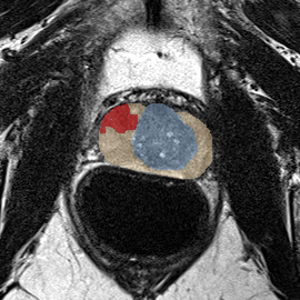 Peripheral-zone lesion, mid-gland (Case 26) MRI preview