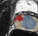 Peripheral-zone lesion, mid-gland (Case 26) lesion zoom preview