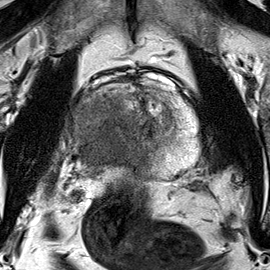 Peripheral-zone lesion, apex (Case 27) T2 axial source preview