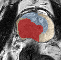 Peripheral-zone lesion, apex (Case 27) lesion zoom preview