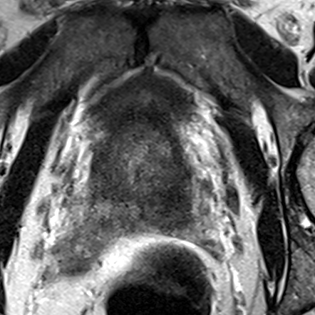 Peripheral-zone lesion, base (Case 28) T2 axial source preview