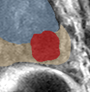 Peripheral-zone lesion, base (Case 28) lesion zoom preview