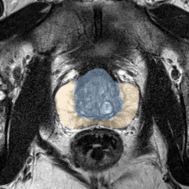Normal gland anatomy, no lesion (Case 29) MRI preview