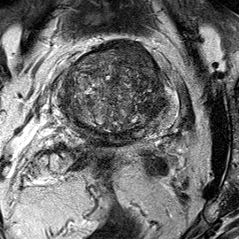 Transition-zone lesion, mid-gland (Case 30) T2 axial source preview