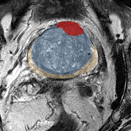 Transition-zone lesion, mid-gland (Case 30) MRI preview
