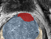 Transition-zone lesion, mid-gland (Case 30) lesion zoom preview