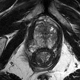 Peripheral-zone lesion, apex (Case 31) T2 axial source preview