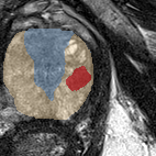 Peripheral-zone lesion, apex (Case 31) lesion zoom preview