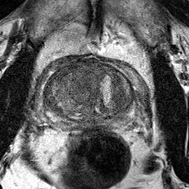 Normal gland anatomy, no lesion (Case 32) T2 axial source preview