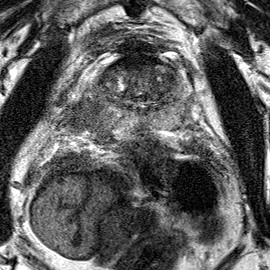 Peripheral-zone lesion, base (Case 33) T2 axial source preview